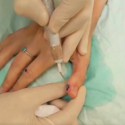 Laser Wart Removal for Fingers + Hands - Wart Removed Fast In Dr's Demonstration