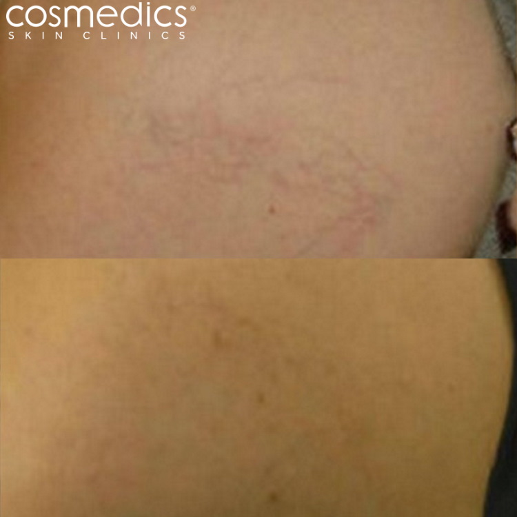 before and after laser thread vein removal harmony