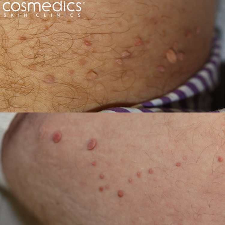 Skin Tags in the Groin - Before Removal
