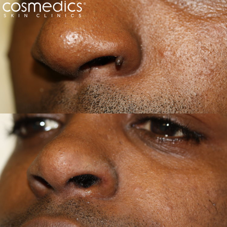 Papilloma on face removal