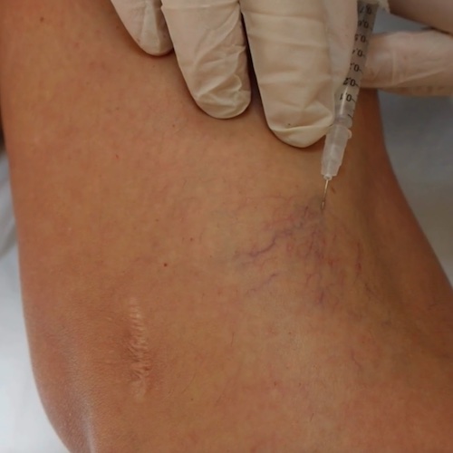 Cosmedics Skin Clinics Thread Vein Injections