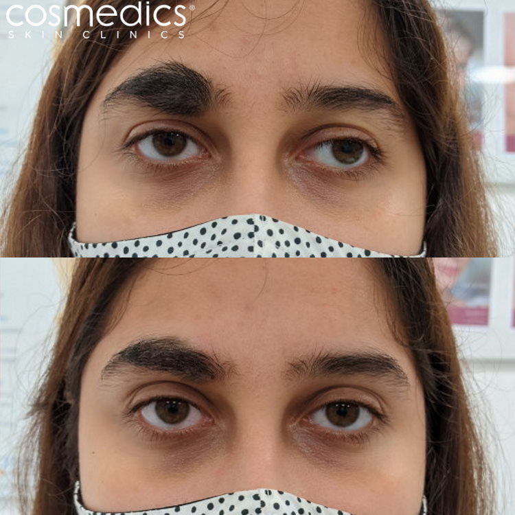 Large eyebrow mole removal before and after