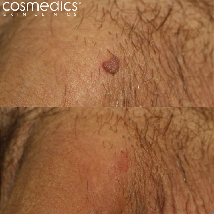 Before and after penis warts