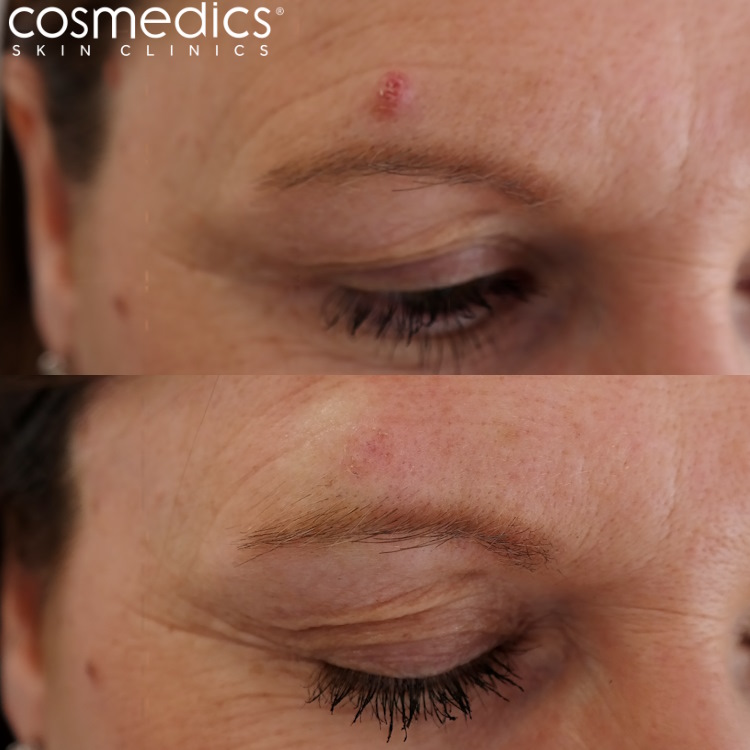 mole removal above eyebrow before and after results