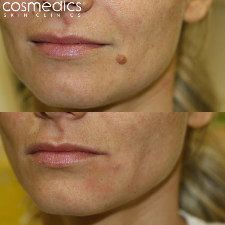 Laser mole removal results - chin