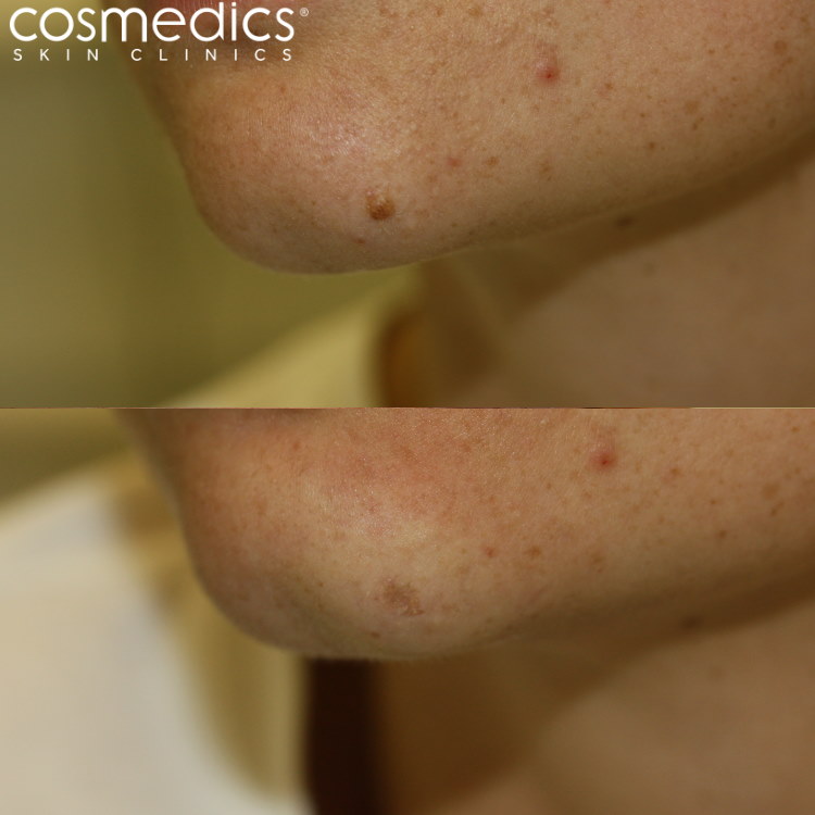 chin mole removal before and after