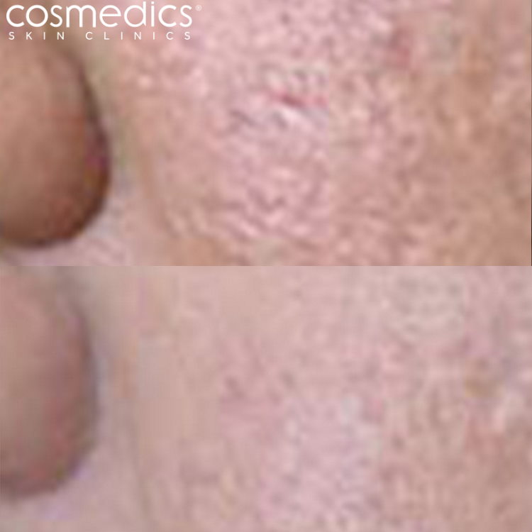 dermaroller before after acne on cheeks