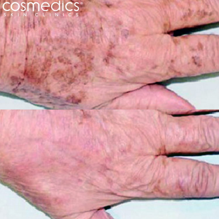 laser pigmentation hands before after