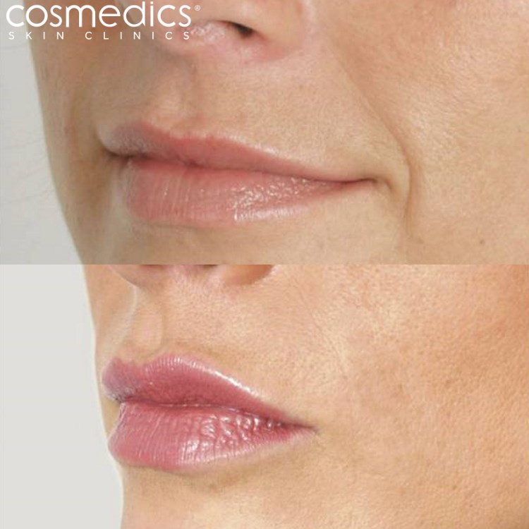 lip enhancement before after