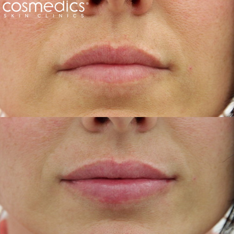 lip enhancement fillers before after