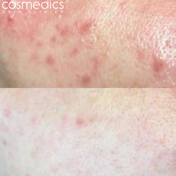 Cheek acne redness - TIXEL treatment results