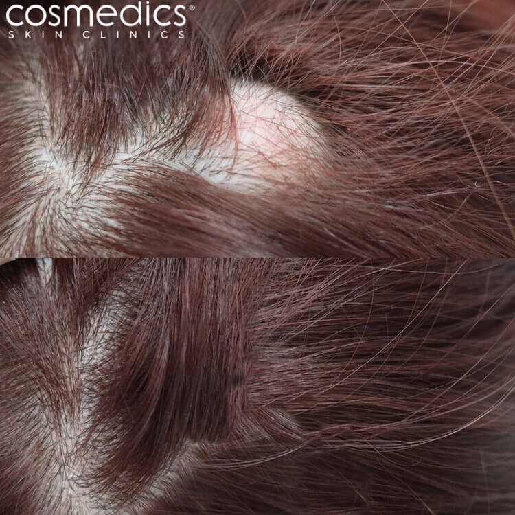 Scalp Cyst Removal Before & After