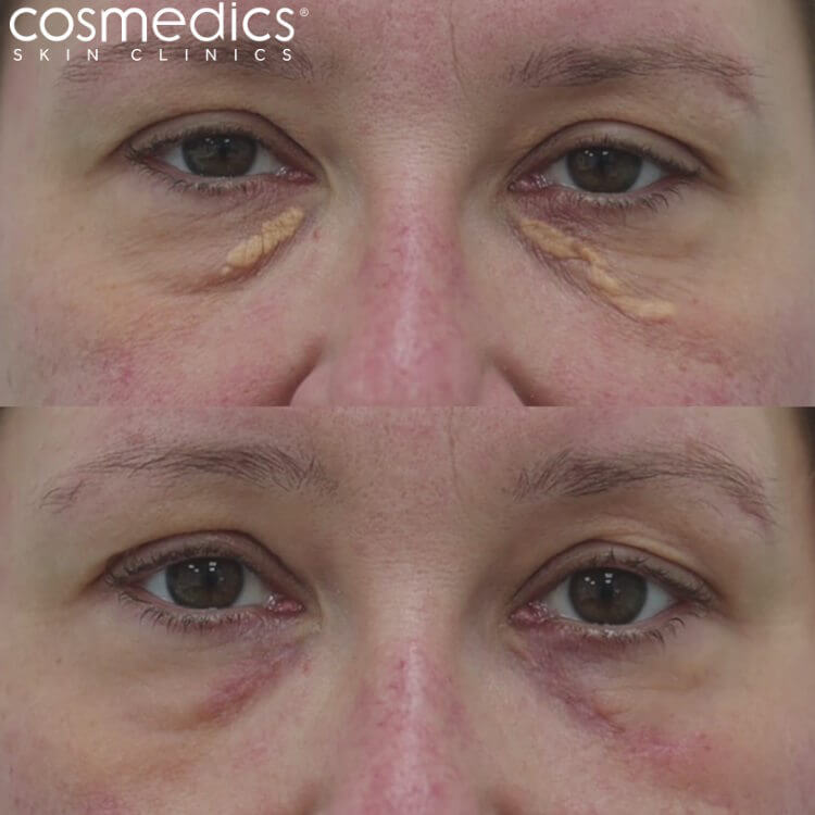 xanthelasma before and after photo