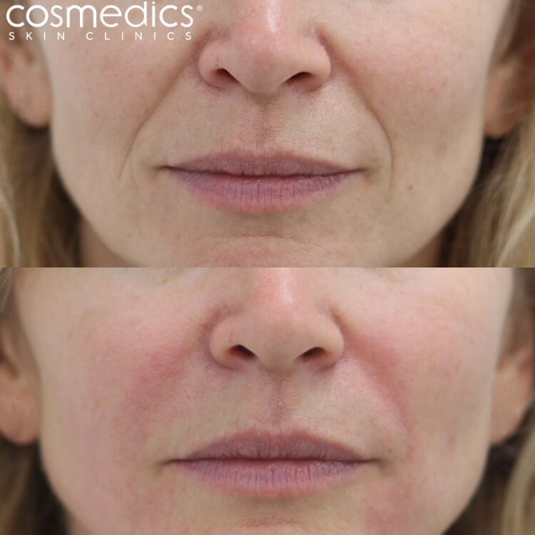 nose to mouth line treatment results