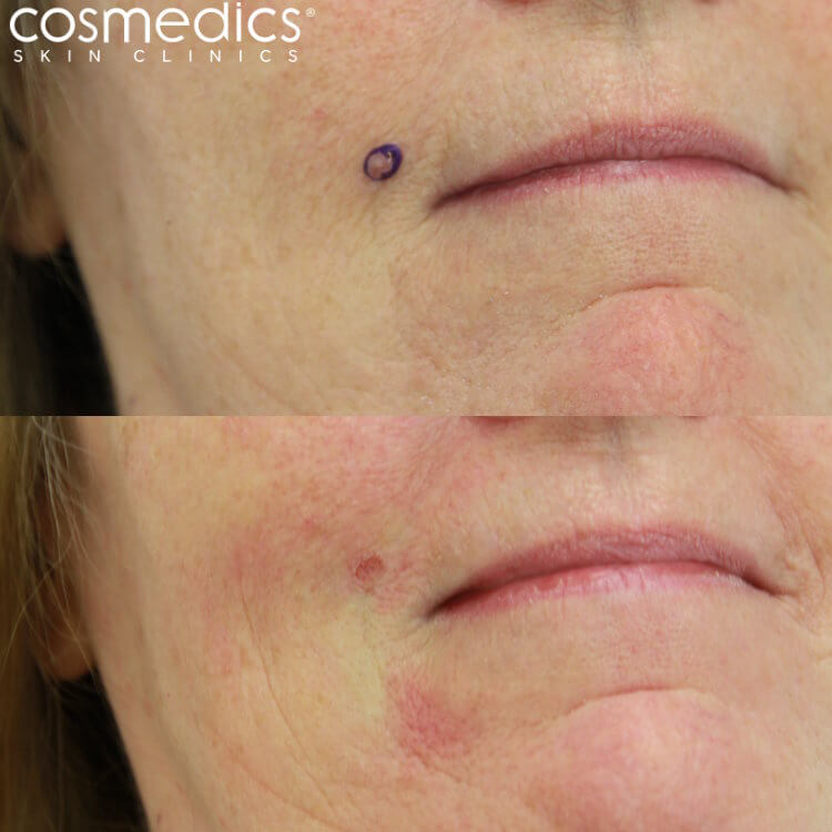 mole removal cheek results