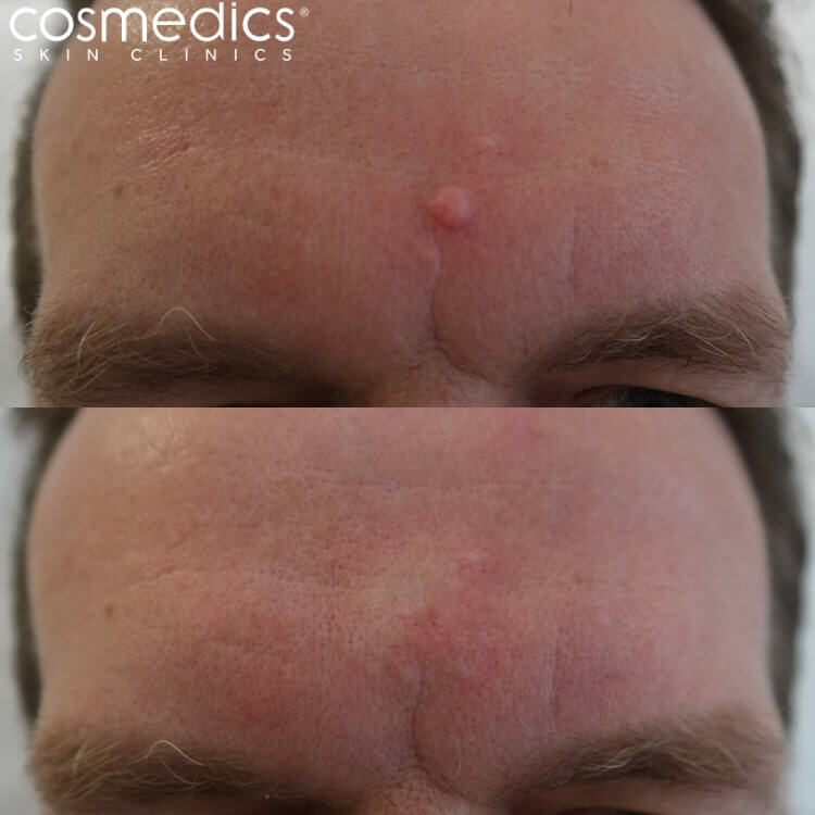 forehead mole removal results