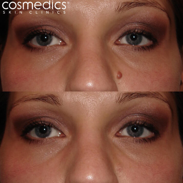 laser nose mole removal