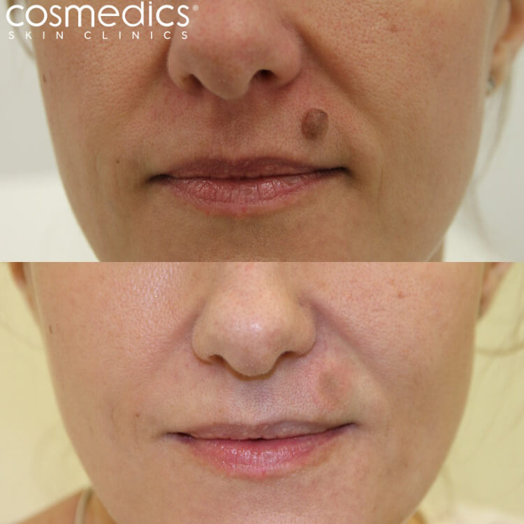 laser mole removal lip before and after