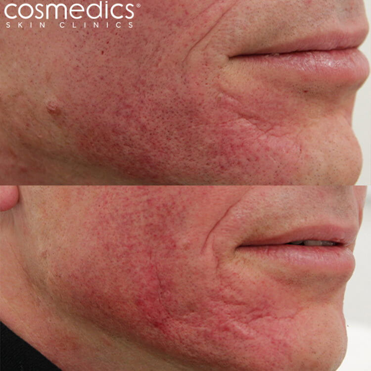 acne scarring treatment results dermaroller filler