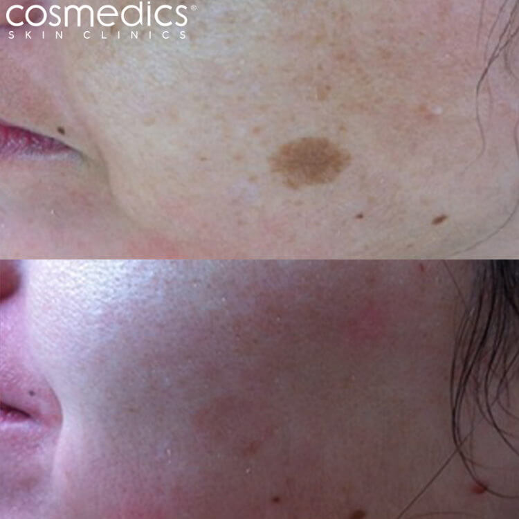 Laser pigmentation treatment before and after