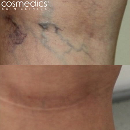 Leg thread veins treatment before and after