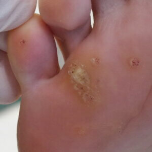 Verruca-wart-on-soles-of-feet-plantar-warts