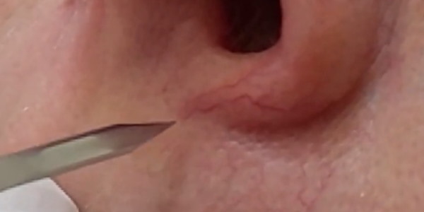 Nose and cheek thread vein removal