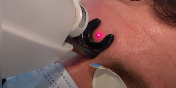 Laser Thread Vein/Angioma Removal - Instant Results