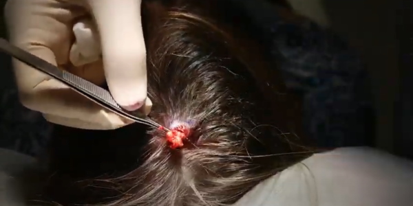 Pilar Cyst Removal