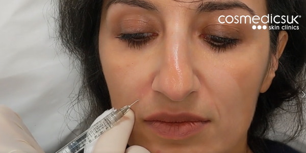 Dermal Fillers Demo - Instant Before and After Results