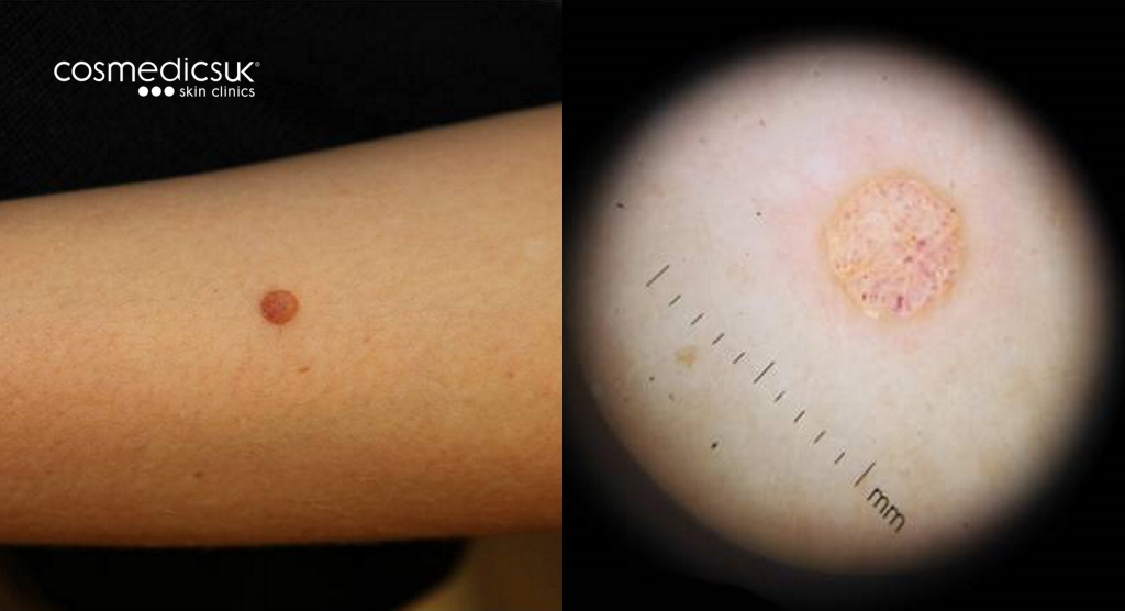Mole check before and after dermoscopy