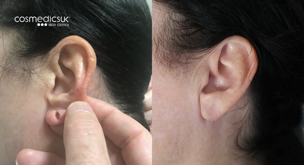 Split earlobe repair results