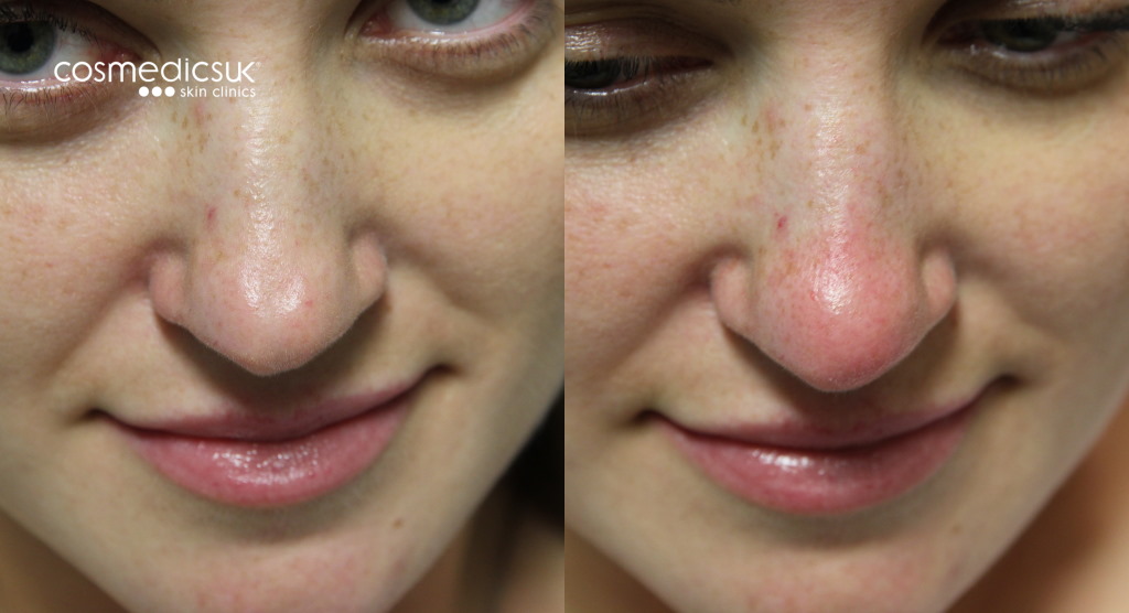 Nose bump treatment
