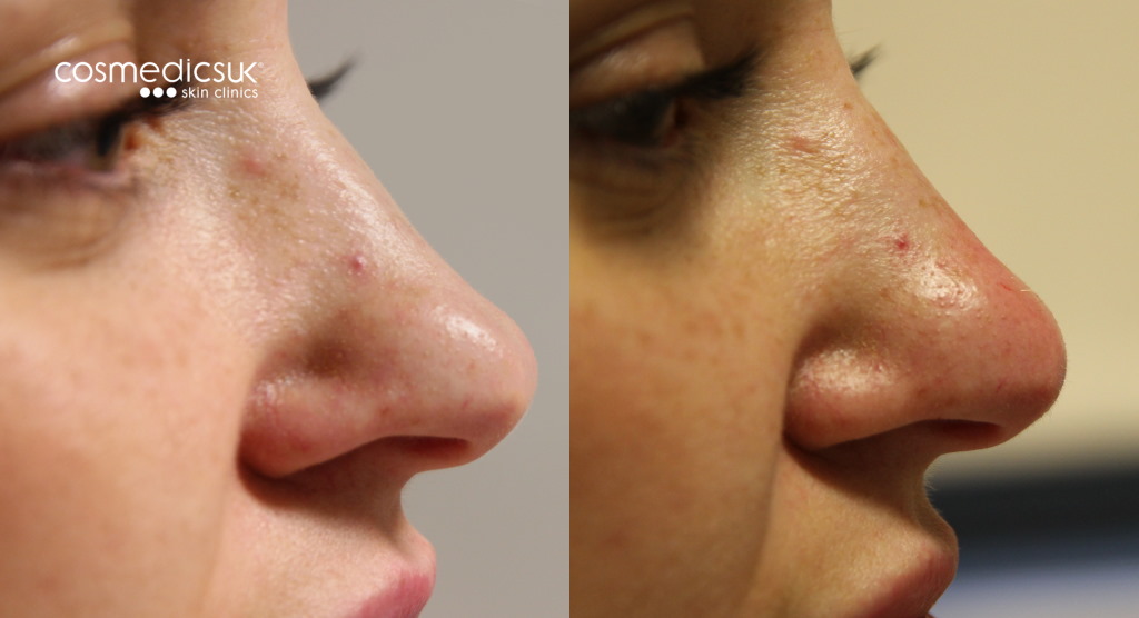 Nose smoothing treatment