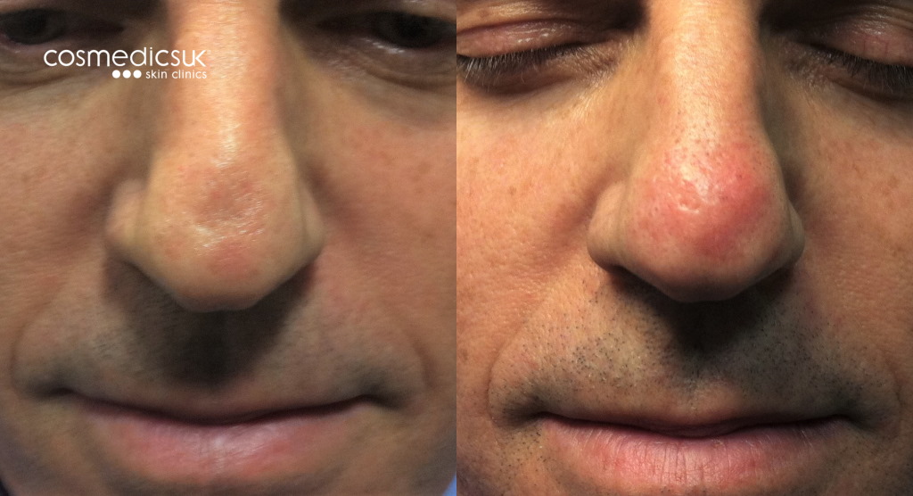 Nose reshaping fillers
