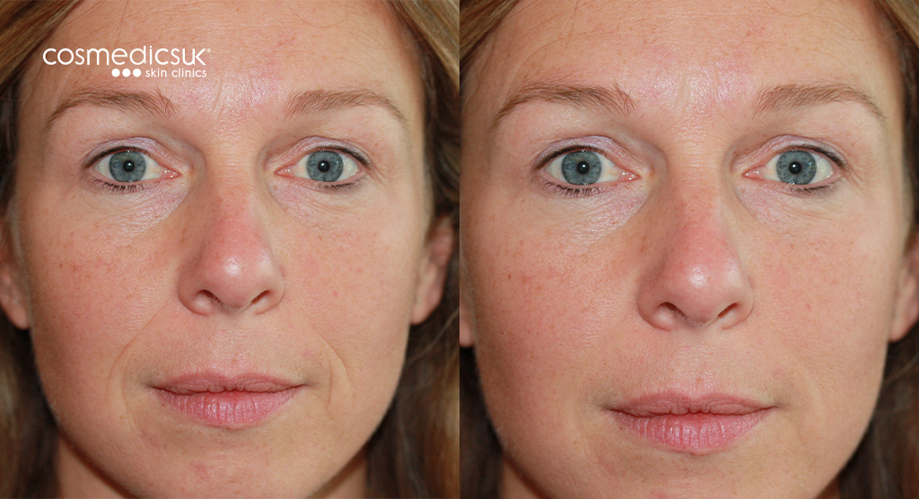 BOTOX Restylane Before and After