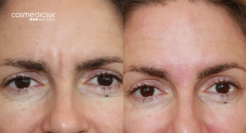 BOTOX frown, forehead lines, eyebrow lift