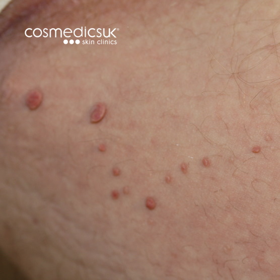Skin tags in groin area
