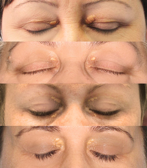 Eyelid-Xanthelasma-removal-clinic