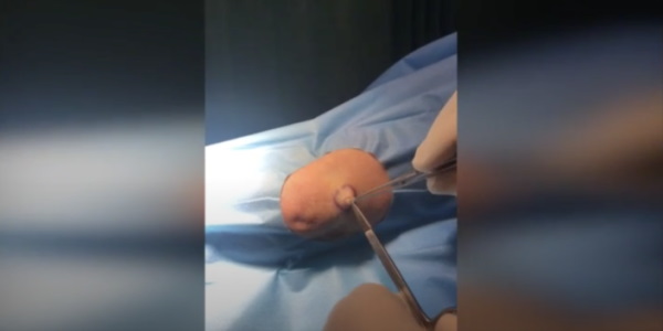 Cyst on arm removal demonstration by Dr Ross Perry