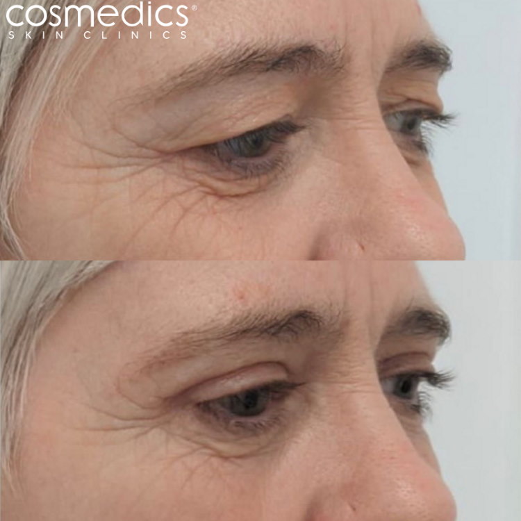 Upper blepharoplasty London before and after