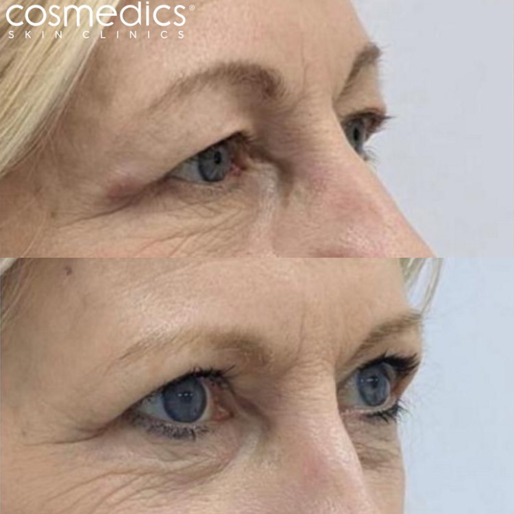 Eyelid lift surgery results