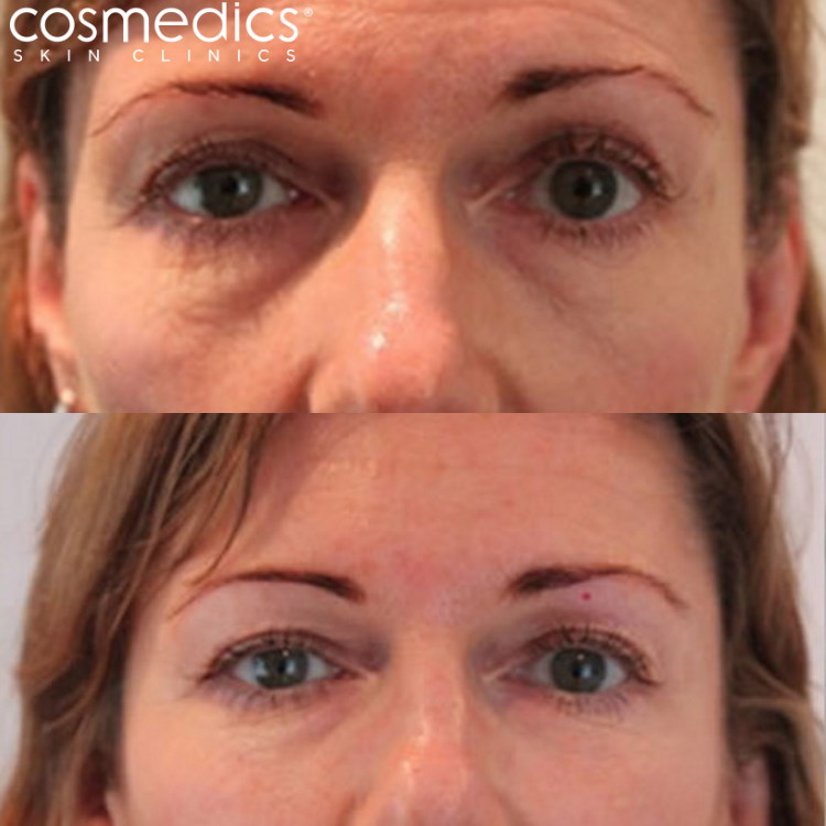 8 point face lift with dermal fillers