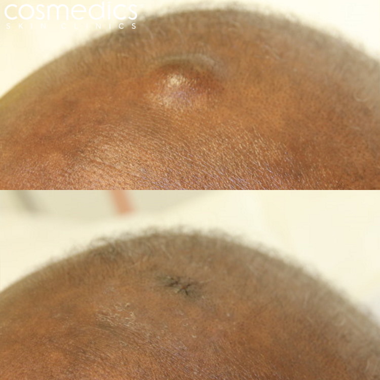 Scalp cyst removal results