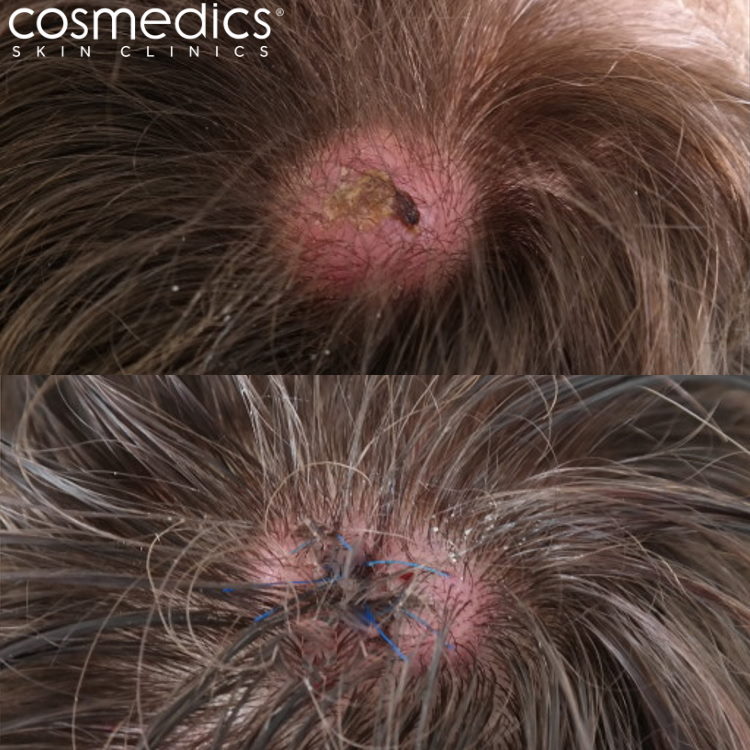 Before and after scalp cyst removal