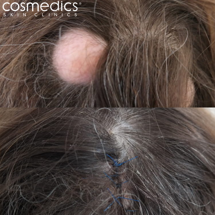 Before and after scalp cyst