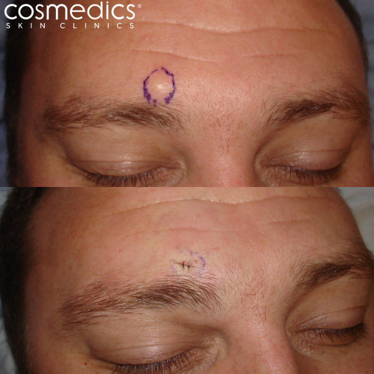 Before and after eyebrow cyst removal
