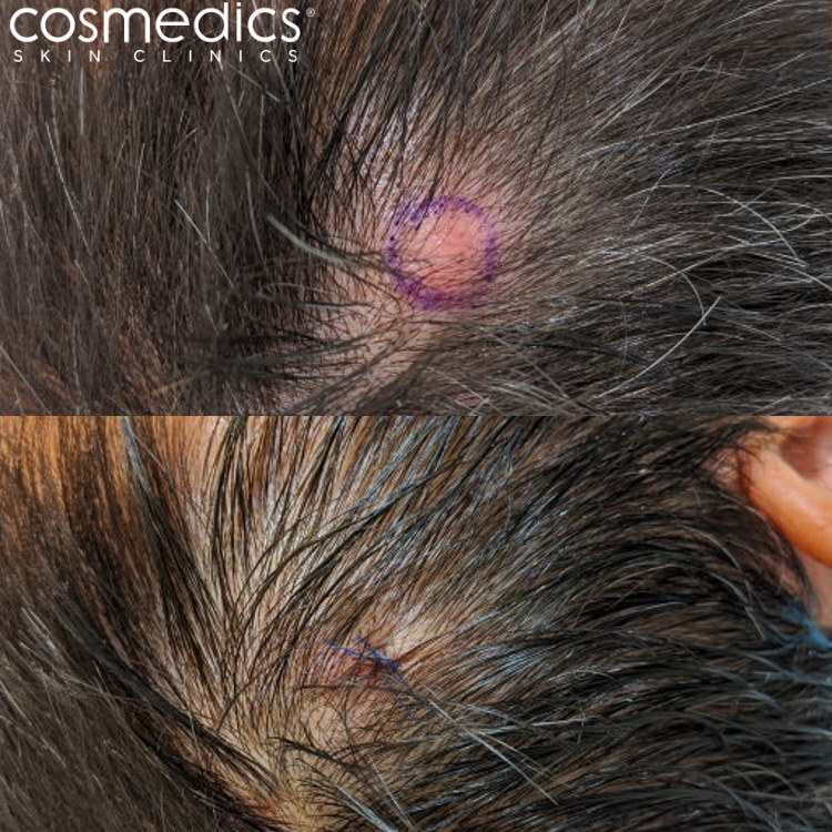Before and after cyst removal scalp