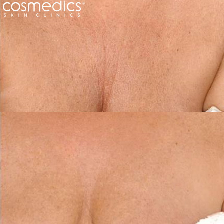 Before and After Decolletage Fillers