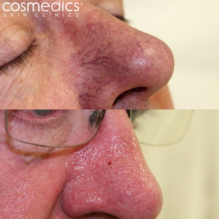 Nose thread veins treatment results
